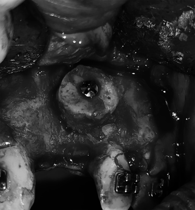 Mandibular symphysis onlay bone graft with i-PRF versus xenograft for maxillary anterior alveolar ridge augmentation: A comparative clinical study.