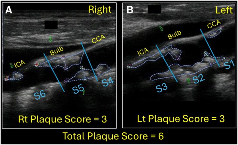 ICEBERG-3: carotid plaque score combined with the stress echo improves 5-year major adverse cardiovascular events risk prediction.