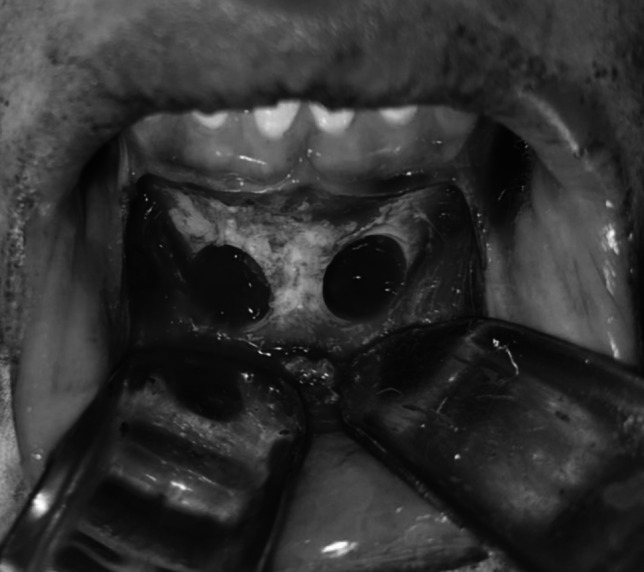 Mandibular symphysis onlay bone graft with i-PRF versus xenograft for maxillary anterior alveolar ridge augmentation: A comparative clinical study.