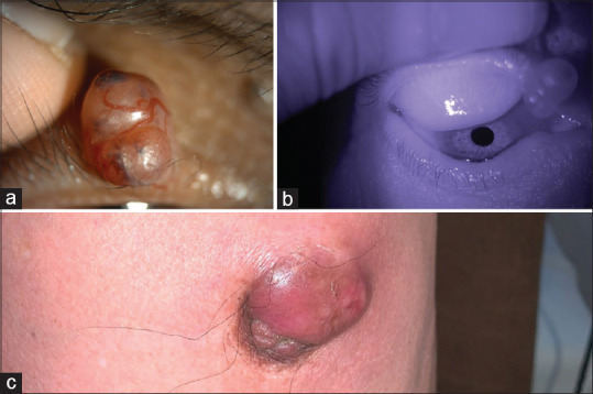 Endocrine mucin-producing sweat gland carcinoma of eyelid as a presenting feature of breast carcinoma in a male patient.