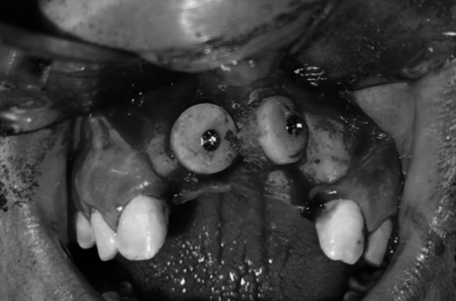Mandibular symphysis onlay bone graft with i-PRF versus xenograft for maxillary anterior alveolar ridge augmentation: A comparative clinical study.