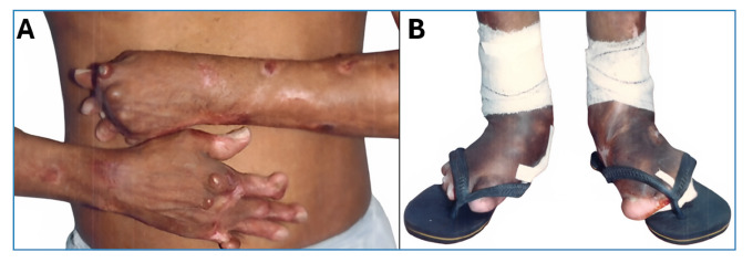 Leishmania (L.) amazonensis Lainson & Shaw, 1972: A cruel parasite causing a high-morbidity disease with severe physical deformities and, secondarily, even death.