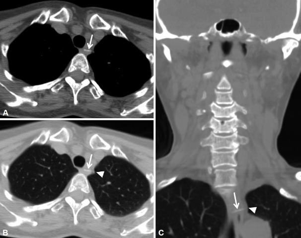 Two Cases of Pneumothorax Induced by Fish Bones Impacted in the Esophagus.