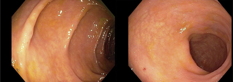 Curcumin-QingDai Combination as Treatment for Crohn's Disease: A Case Report.