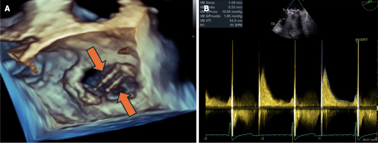 Thrombolysis in dysfunctional valve and stroke.