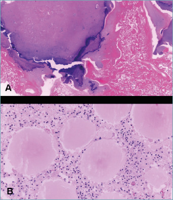Histological and proteomic characterization of musculoskeletal amyloidomas.