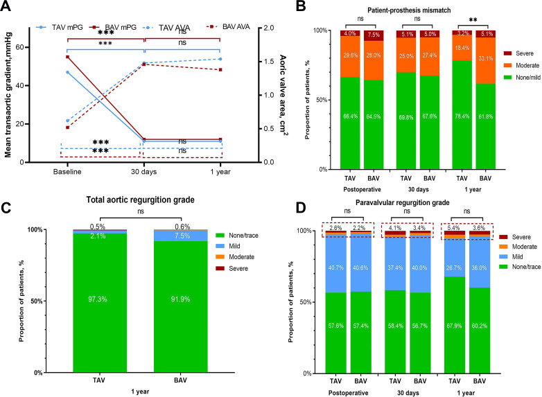 Transcatheter bicuspid versus tricuspid aortic valve replacement in patients with a small aortic annulus: an observational study.
