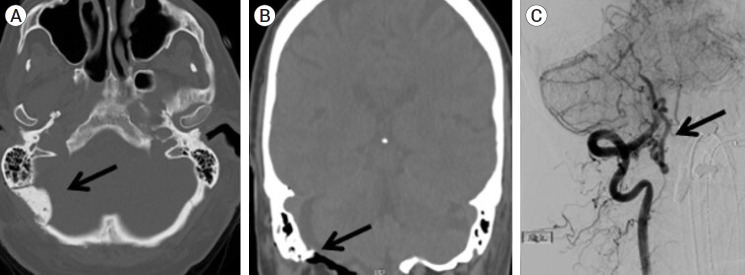 Endovascular flow diversion treatment of spontaneous craniocervical junction vertebral artery dural fistula and literature review.