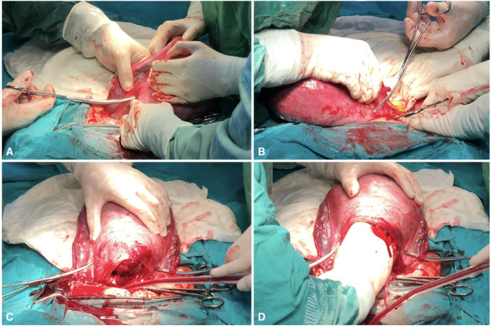 The Çepni modification: using bilateral vascular clamps during caesarean section for intrapartum hemorrhage, a randomized controlled trial.