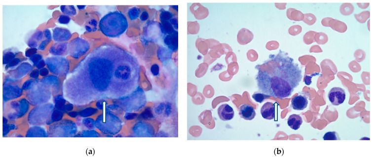 Secondary Hemophagocytic Lymphocytosis in Inflammatory Bowel Disease.