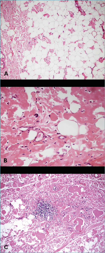 Histological and proteomic characterization of musculoskeletal amyloidomas.