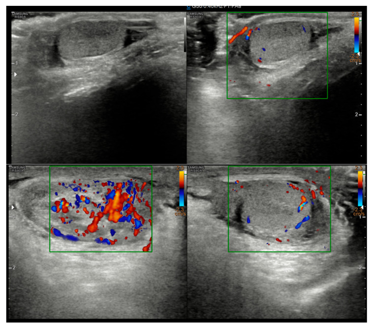 <i>Dirofilaria repens</i> in the Spermatic Cord of a 5-Year-Old Boy: A Rare Pediatric Case in Italy.