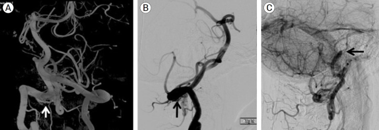 Endovascular flow diversion treatment of spontaneous craniocervical junction vertebral artery dural fistula and literature review.