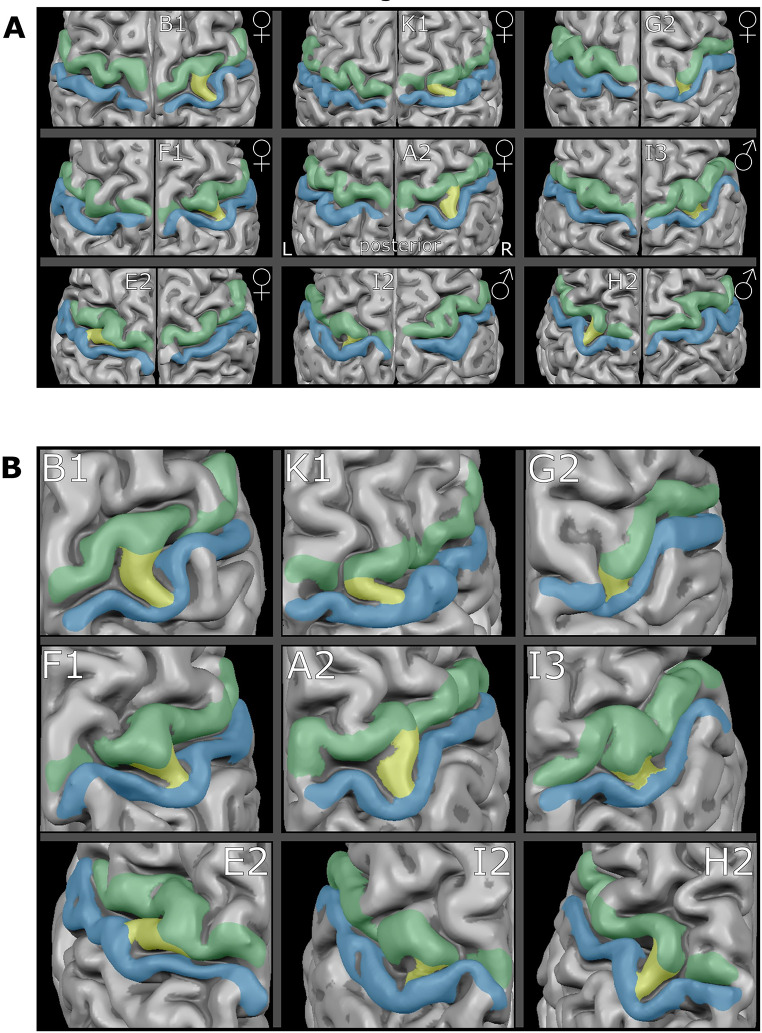 The deep winding at the brain surface: replicating a historical report associating the 'bridged' central sulcus with the pli de passage fronto-pariétal moyen.