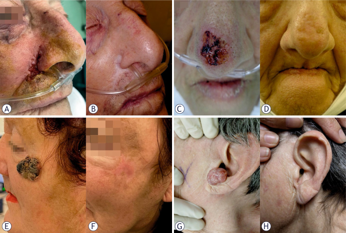 Electrochemotherapy for basal cell carcinoma in the head and neck region: 5-year follow-up from the Insp-ECT registry.