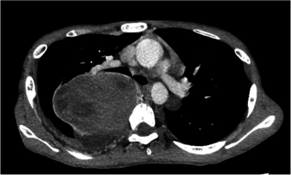 What is safe paravertebral block and neuraxial anesthesia for patients with neurofibromatosis type 1?