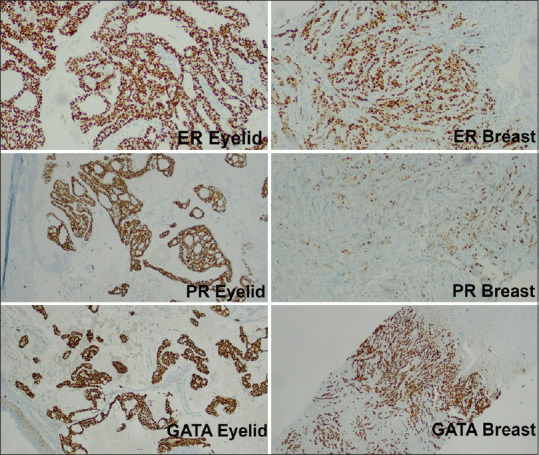 Endocrine mucin-producing sweat gland carcinoma of eyelid as a presenting feature of breast carcinoma in a male patient.