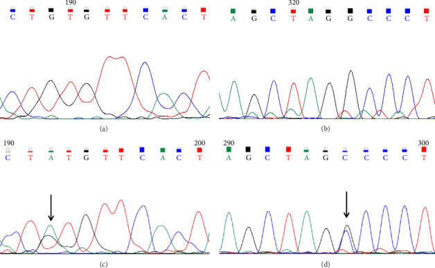 Fujian Province β-Thalassemia: A Molecular and Hematological Study in Southeastern China.