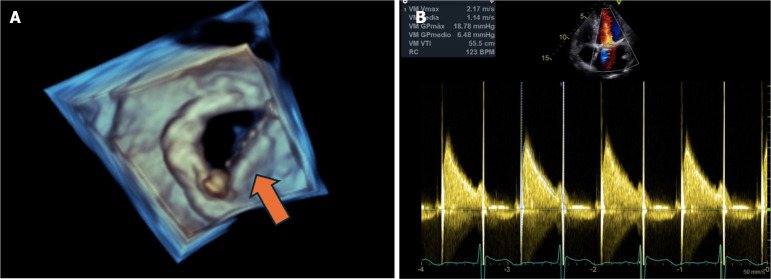 Thrombolysis in dysfunctional valve and stroke.