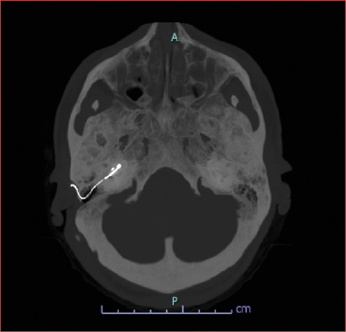 Surgical options for advanced otosclerosis.