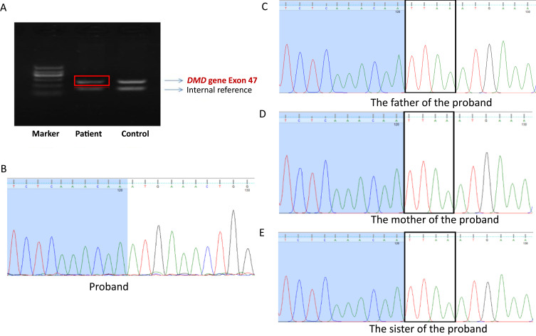 Molecular Genetic Analysis of a <i>DMD</i> Frameshift Mutation in a Boy with Duchenne Muscular Dystrophy by MLPA and Sanger Sequencing.