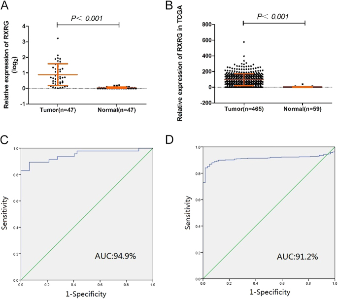 Retinoid X receptor γ regulates epithelial-mesenchymal transition and tumor immune infiltration in papillary thyroid cancer tumorigenesis: an experimental and in silico study.