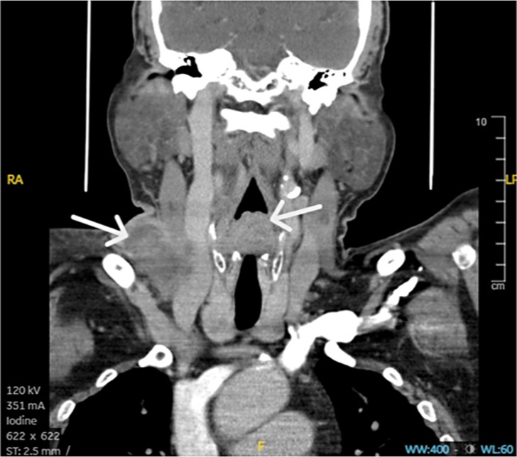 Administration of a Single Dose of Pembrolizumab, Docetaxel, and Cisplatin Leads to Complete Disappearance of a Locally Advanced Hypopharyngeal Squamous Cell Carcinoma: A Case Report.