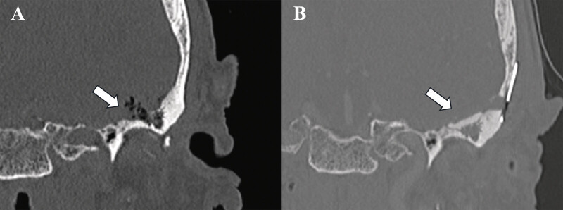 Management of Rare Temporomandibular Joint Cysts with Intracranial Extension: A Case Series and Literature Review.
