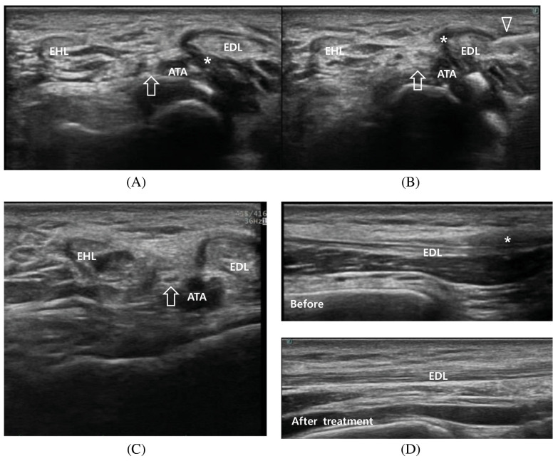 Tendinopathy Pain Mimicking Neuropathy on Nerve Conduction Study Resolved with Ultrasound-Guided Steroid Injection Treatment: A Case Report.