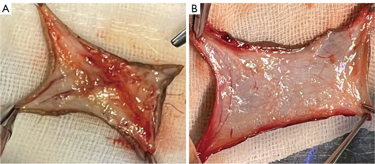 A novel autologous material for the surgical treatment of Peyronie's disease: the outer plate of the prepuce.