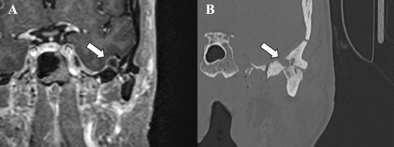 Management of Rare Temporomandibular Joint Cysts with Intracranial Extension: A Case Series and Literature Review.