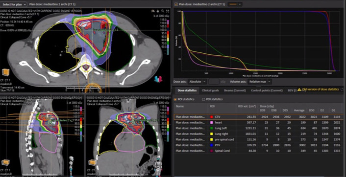Complete pathologic response after concomitant pembrolizumab and radiotherapy in a patient with pretreated metastatic thymic carcinoma: a case report.
