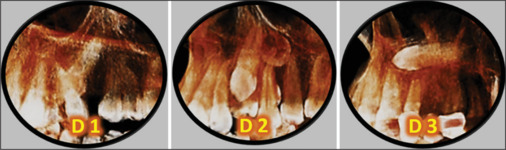 Impacted canine prevalence, localization, and related etiological factors among orthodontic sample of Fallujah city.