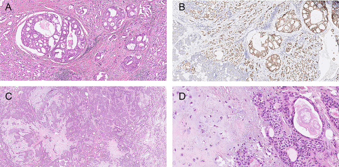 Bilateral synchronous salivary gland tumors: report of three cases.