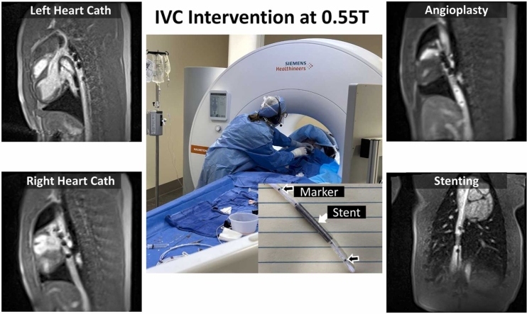 Feasibility of magnetic resonance imaging-guided cardiac catheterization, angioplasty, and stenting in a commercial wide-bore 0.55T scanner.