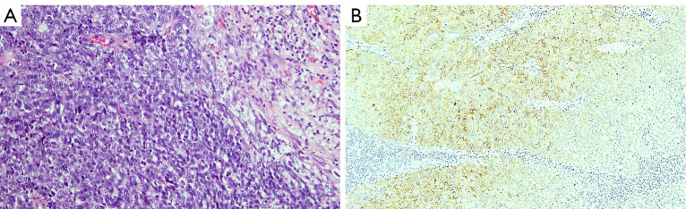 Complete pathologic response after concomitant pembrolizumab and radiotherapy in a patient with pretreated metastatic thymic carcinoma: a case report.