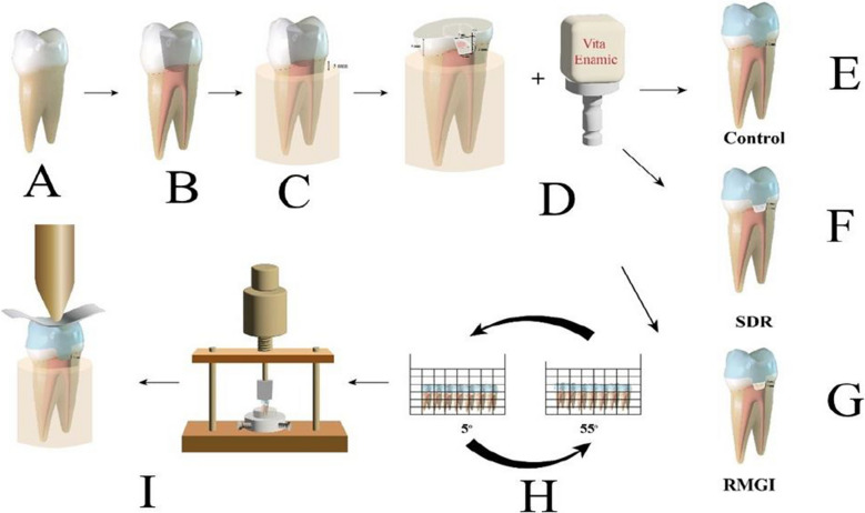 Impact of deep margin elevation on premolar endo-crown's fracture resistance after thermocycling: an in vitro study.