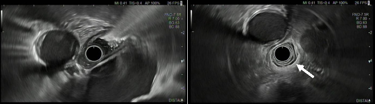Late Onset of Pseudoachalasia in Anti-Hu-Associated Syndrome.