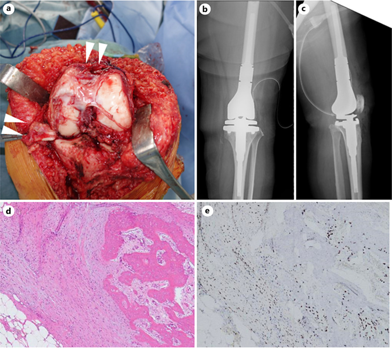 Beta-Catenin Positive Giant Cell Tumor of Bone with Pathological Fracture Treated with Neoadjuvant Denosumab Therapy for Visualizing Extraskeletal Lesions.