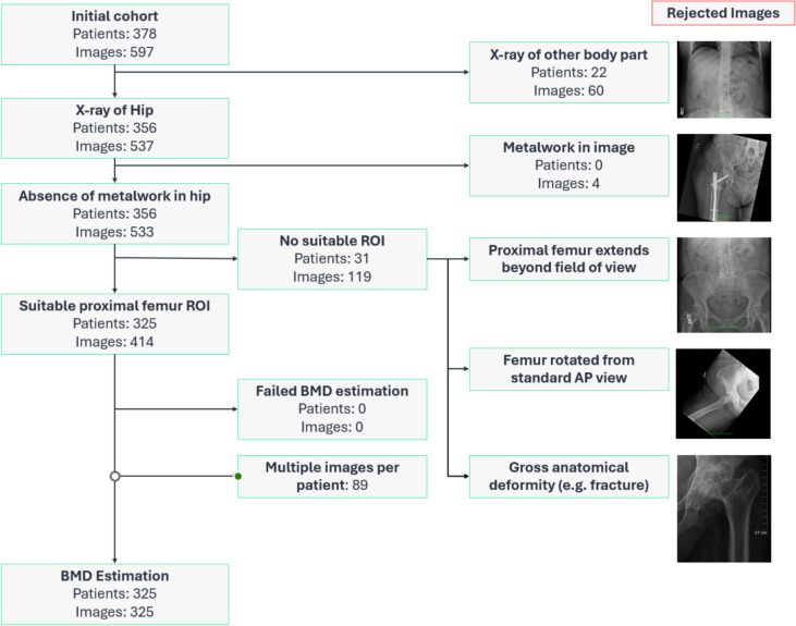 Opportunistic assessment of osteoporosis using hip and pelvic X-rays with OsteoSight™: validation of an AI-based tool in a US population.