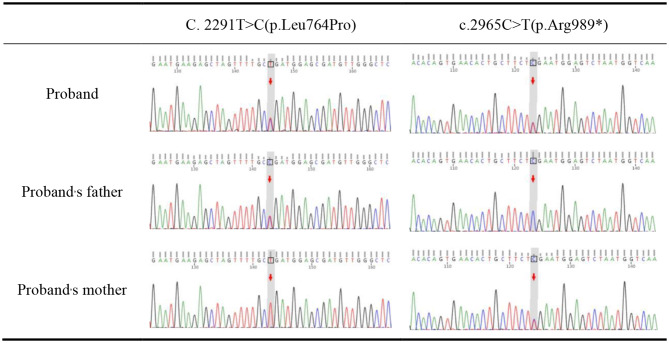 A novel variant in NPR2: C.2291T > C (p.Leu764Pro) identified in a patient with acromesomelic dysplasia Maroteaux type.