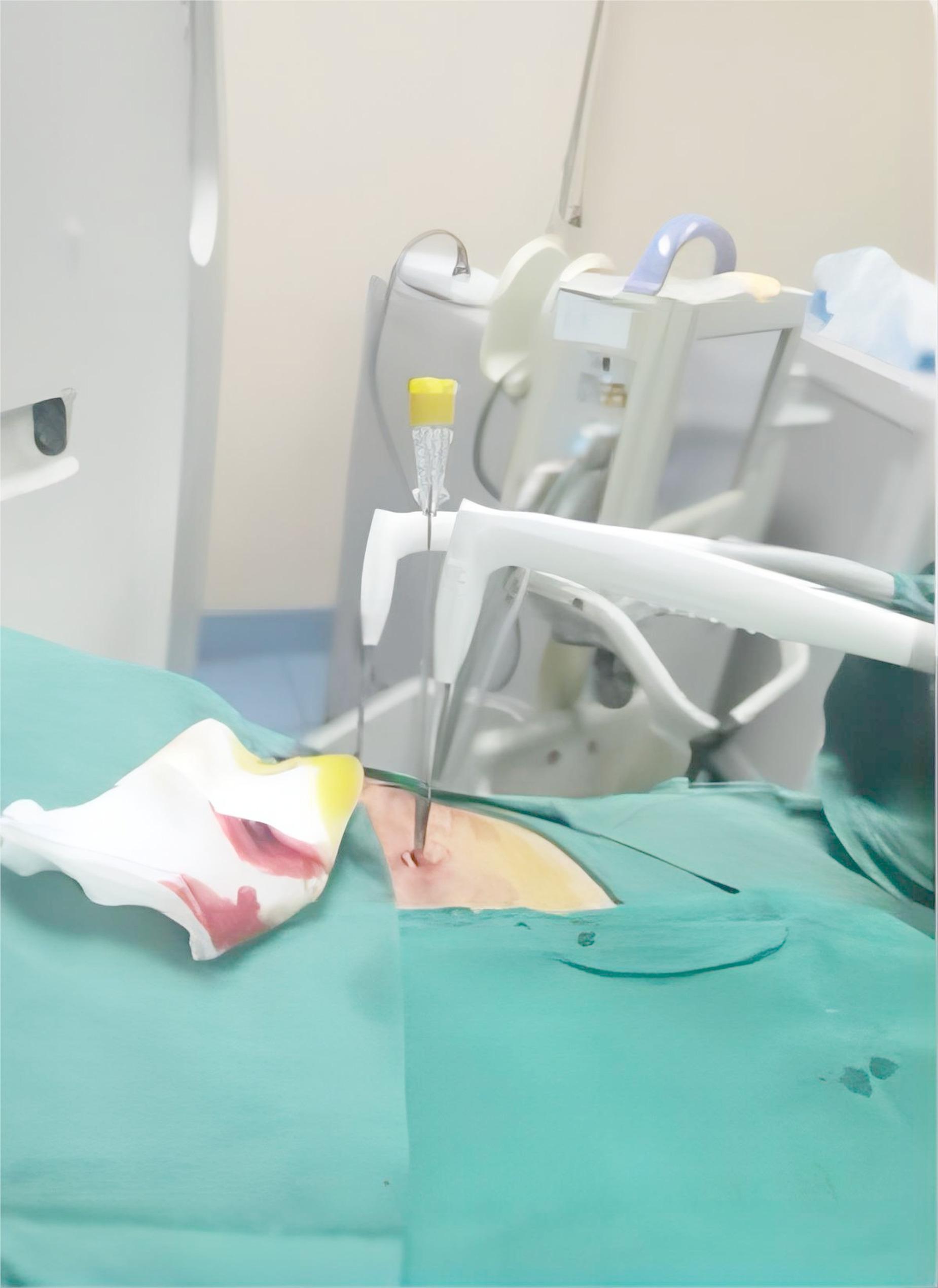 Efficacy and safety in synchronous core-needle biopsy and cryoablation for highly suspicious malignant pulmonary nodule.