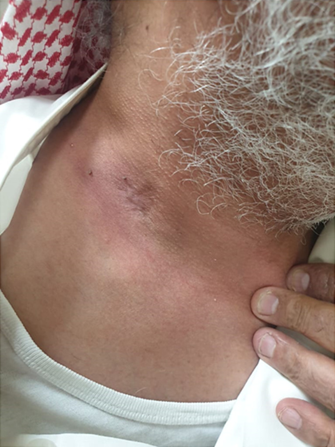Administration of a Single Dose of Pembrolizumab, Docetaxel, and Cisplatin Leads to Complete Disappearance of a Locally Advanced Hypopharyngeal Squamous Cell Carcinoma: A Case Report.