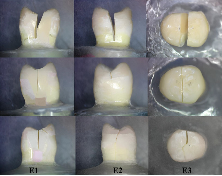 Impact of deep margin elevation on premolar endo-crown's fracture resistance after thermocycling: an in vitro study.