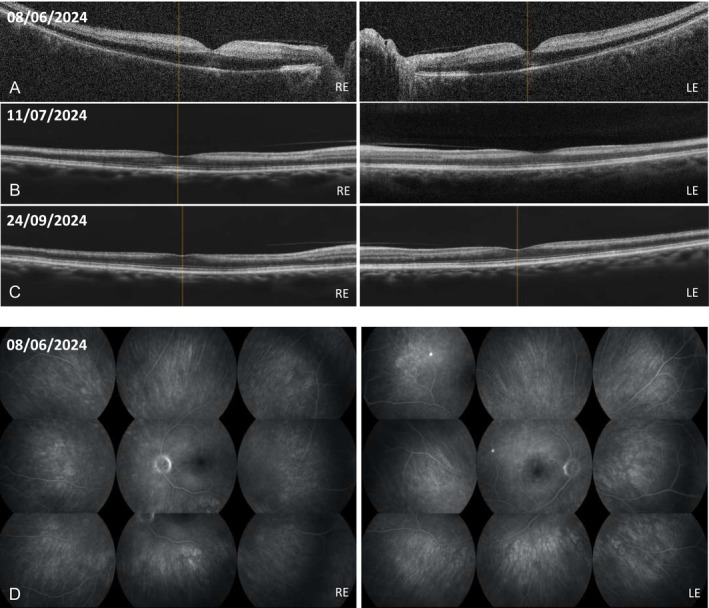 Development of Eosinophilic Granulomatosis With Polyangiitis Despite Anti-Interleukin-5 Receptor Therapy: The First Case of Bilateral Central Retinal Artery Occlusion During Benralizumab Treatment.