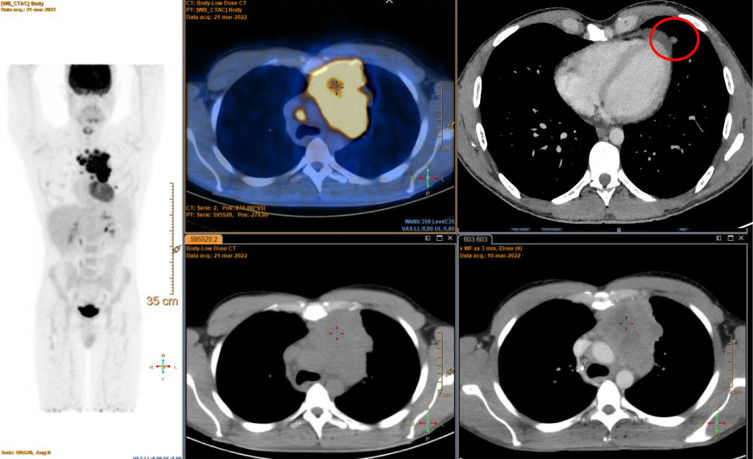 Complete pathologic response after concomitant pembrolizumab and radiotherapy in a patient with pretreated metastatic thymic carcinoma: a case report.