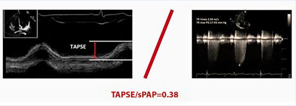 Right ventricular uncoupling in acute heart failure with preserved or mildly reduced ejection fraction: a simple parameter to predict long-term mortality.