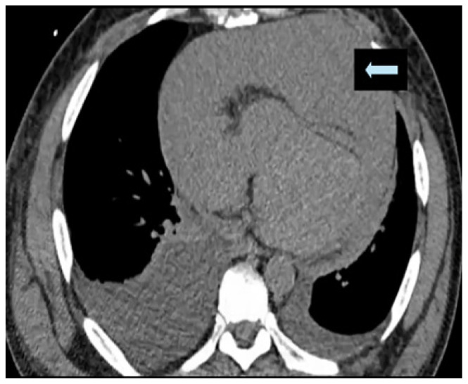 Metastatic Cardiac Angiosarcoma Presenting as Superior Vena Cava Syndrome and Cardiac Tamponade.