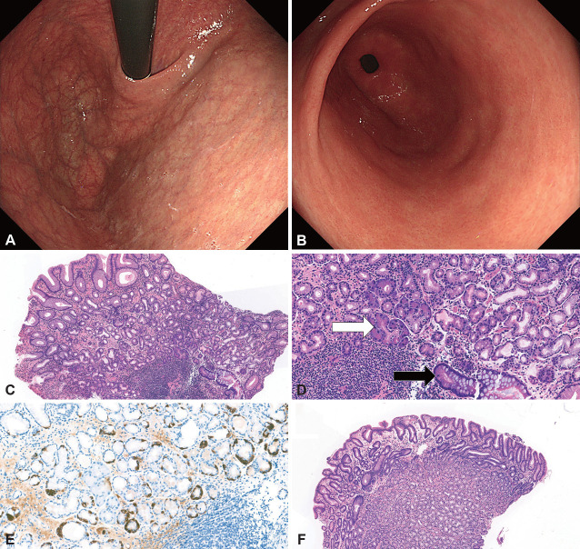Autoimmune Gastritis: Unveiling the Mystery.