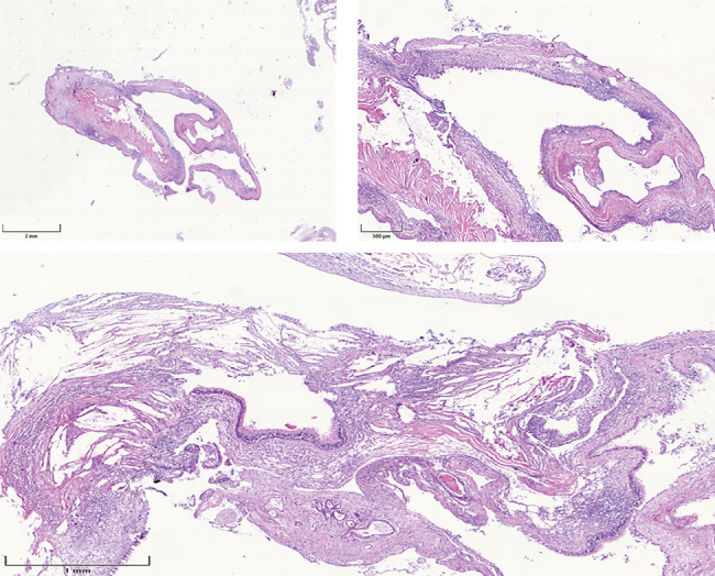 Symptomatic Maxillary Sinus Retention Cyst Following a Prior Sinus Perforation: A Case Report.